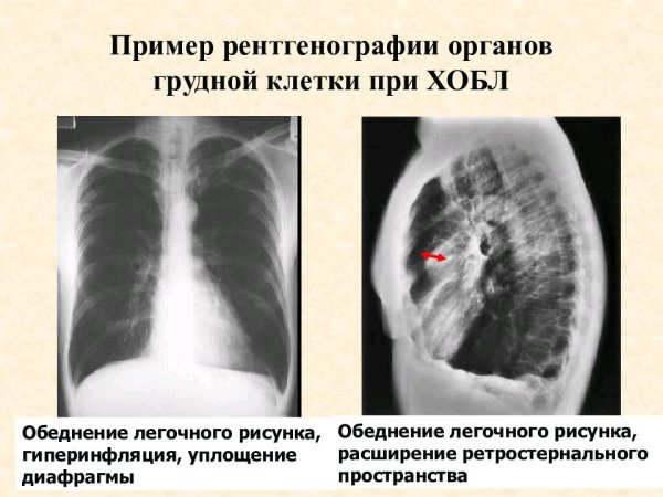 Синдром патологических изменений легочного рисунка