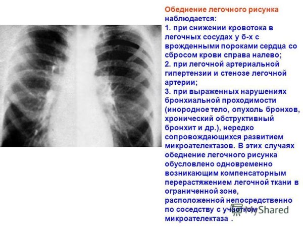 Эмболия легочной артерии рентген