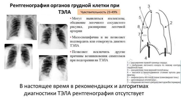 Ячеистая деформация легочного рисунка
