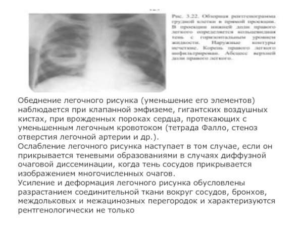 Легочный рисунок