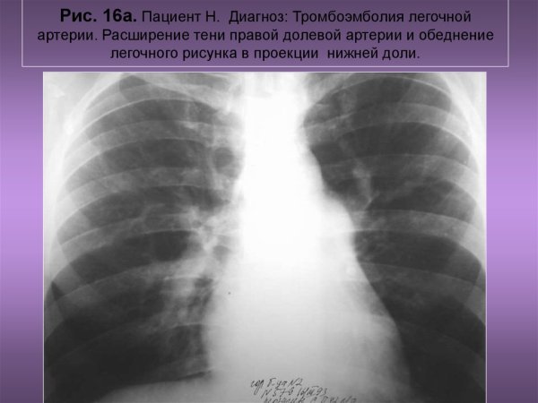 Ангиопульмонография Тэла