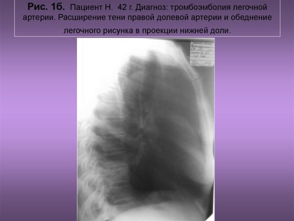 Рентгенография органов грудной клетки ХОБЛ
