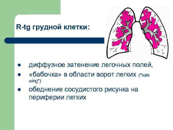 Диффузное усиление легочного рисунка