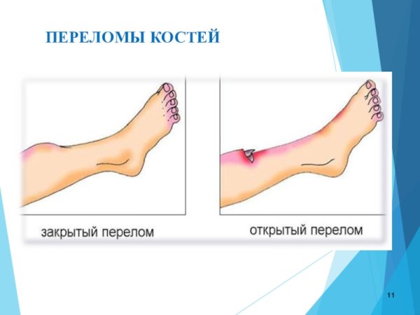 Открытый перелом костей