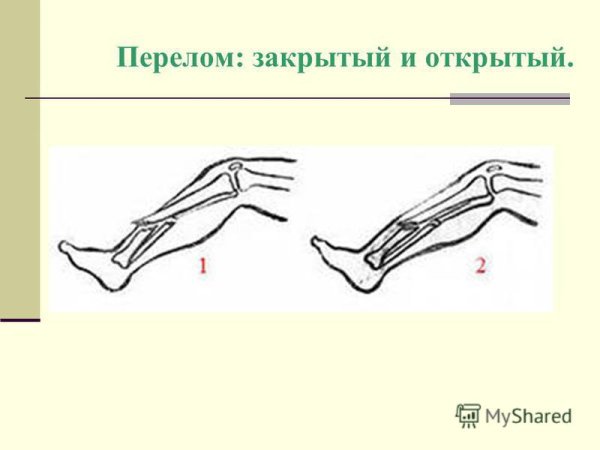 Открытый и закрытый перелом