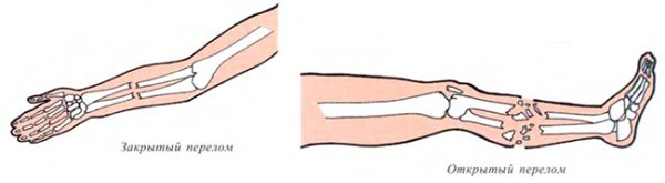 Открытый перелом перелом