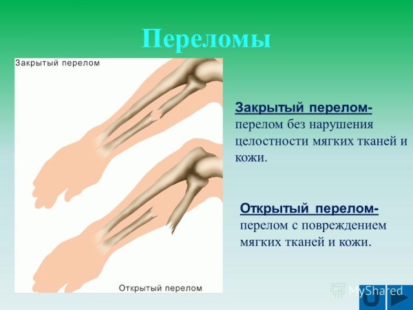 Презентация на тему открытый перелом