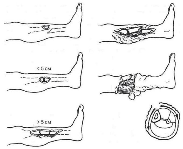 Открытый перелом ноги степень