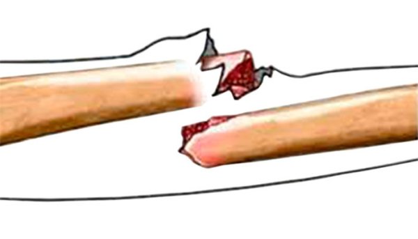 Открытые переломы костей