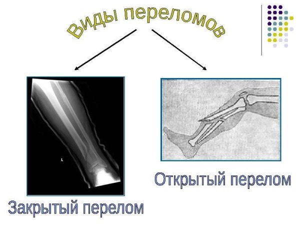 Открыты и закрытые трещенв