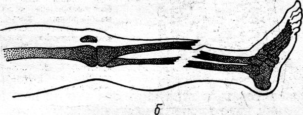 Закрытый перелом ноги схема