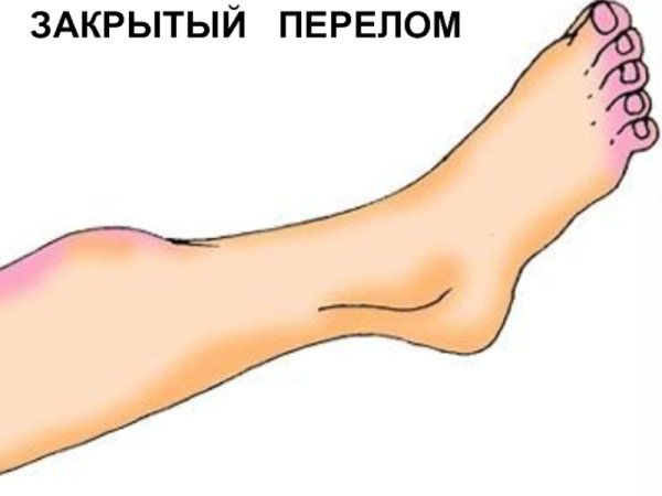 Закрытый перелом рисунок