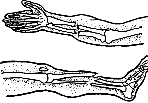 Открытый и закрытый перелом кости