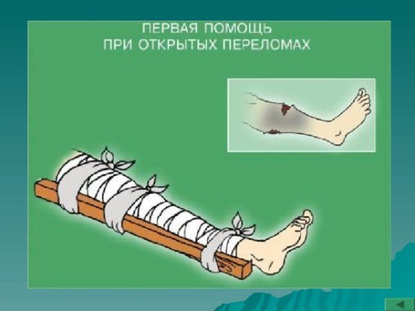Оказание ПМП при переломе ноги