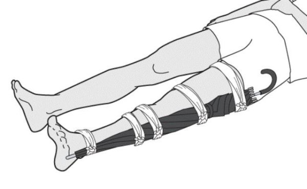 При открытом переломе голени шина накладывается