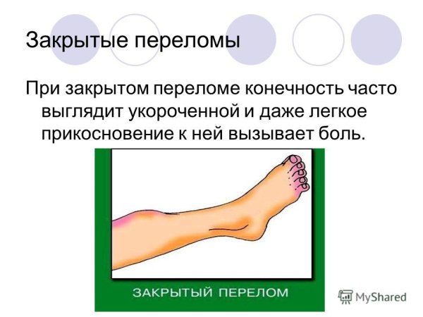 Закрытые переломы конечностей