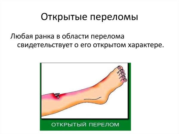 Первично открытый перелом