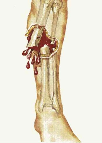 Открытый перелом голени