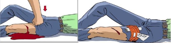 Бедренное кровотечение ПМП