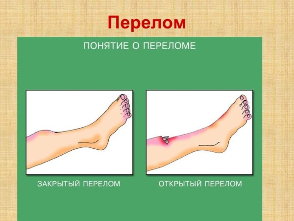 Закрытый перелом и открытый перелом