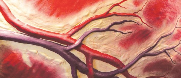 Тромбофлебит паховой вены