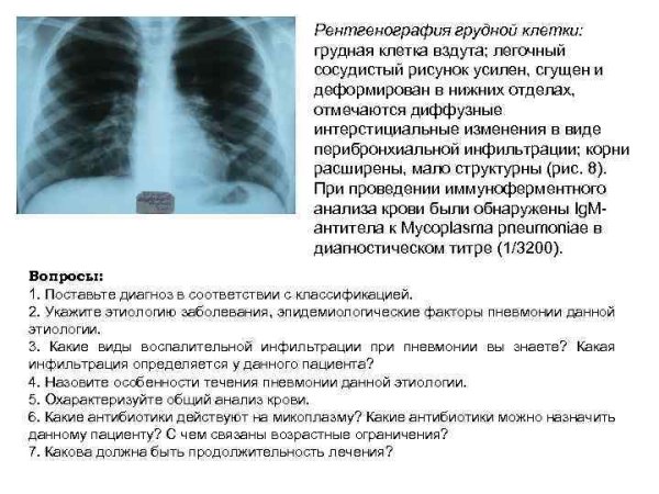 Легочный рисунок сгущен