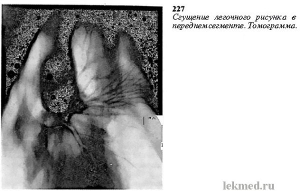 Легочный рисунок деформирован