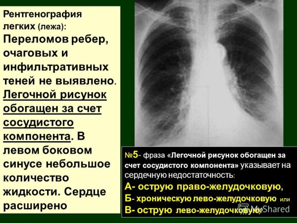 Эмфизема лёгких на рентгенограмме
