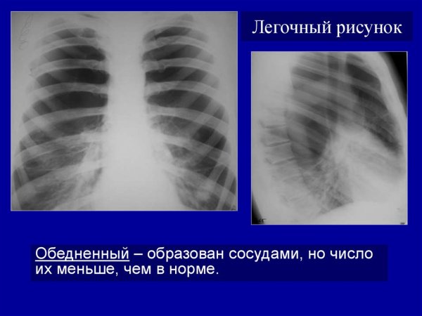 Легочный рисунок обогащен