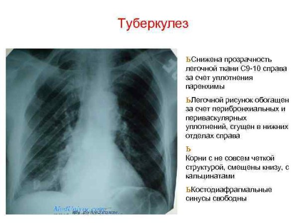 Рентгенограммы органов грудной клетки пневмония