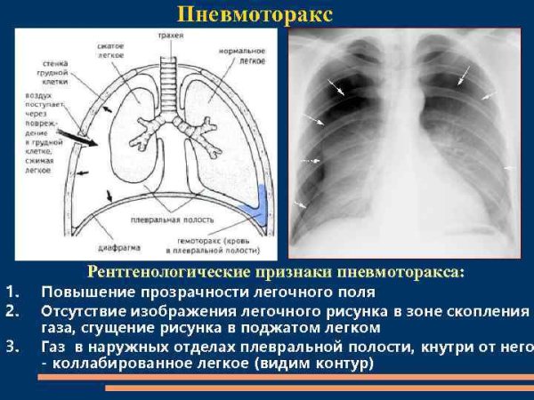 Анализ легочного рисунка