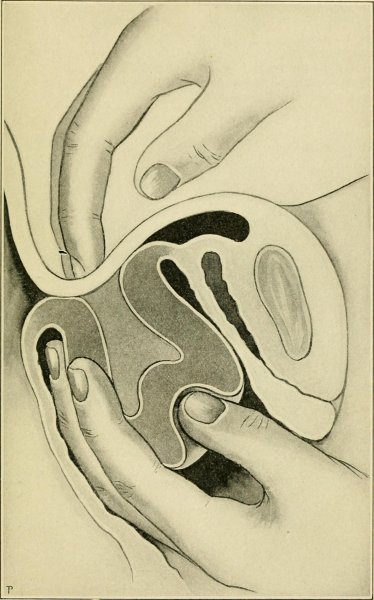 Выворачивание влагалища