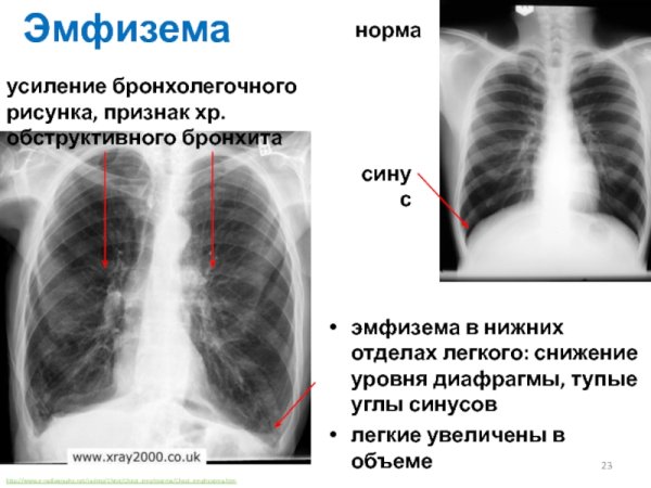 Усиление легочного рисунка причины