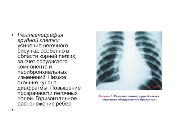 Усиление легочного рисунка