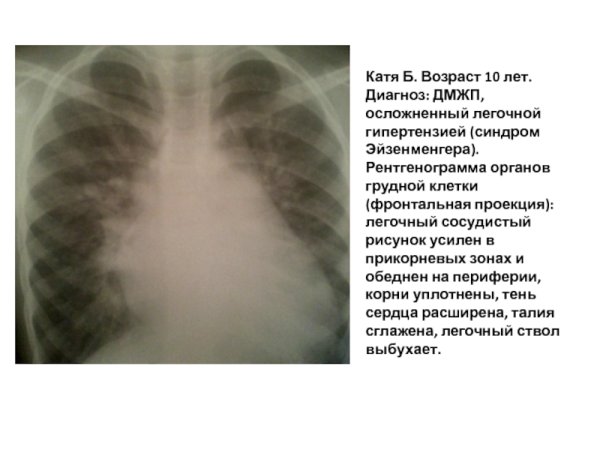 Легочный рисунок деформирован