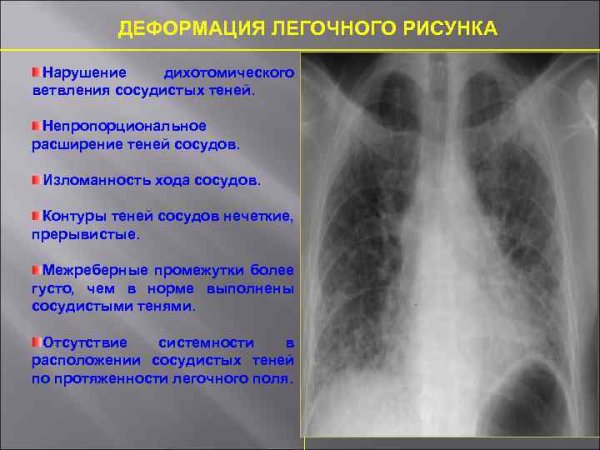 Разрешенная пневмония