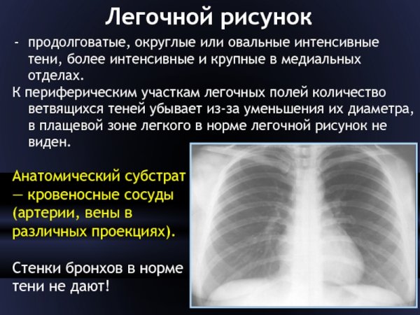 Пневмокониоз легких 1 стадия рентген