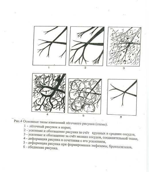 Изменение легочного рисунка заболевания