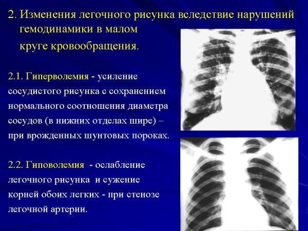 Синдром патологических изменений легочного рисунка