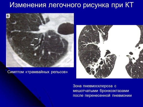Синдром обогащения легочного рисунка