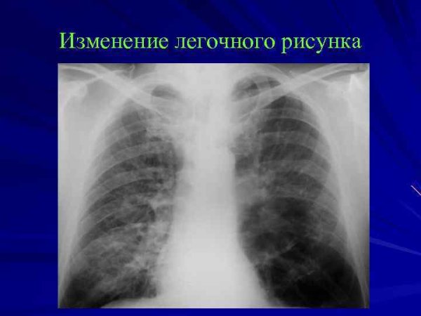 Линейный фиброз на рентгене