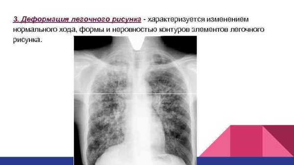 Перибронхиальный фиброз при ХОБЛ