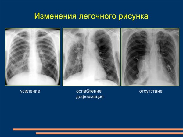 Изменение легочного рисунка на рентгенограмме