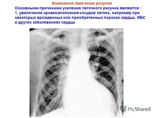 Легочный рисунок усилен