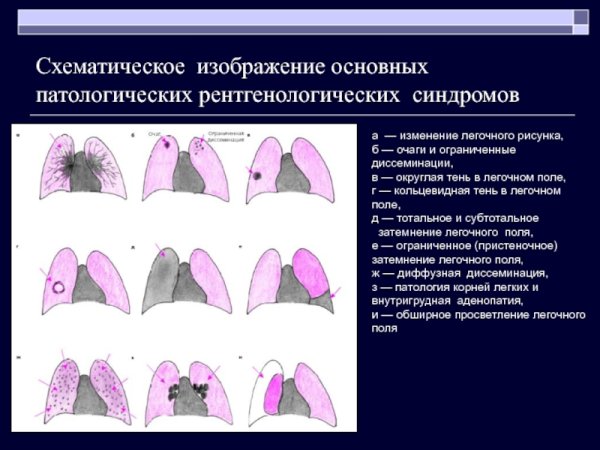 Синдром деформации легочного рисунка