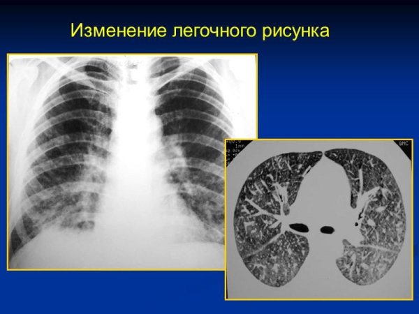 Легочный рисунок