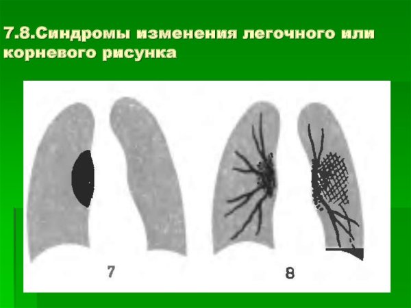 Патология легочного рисунка