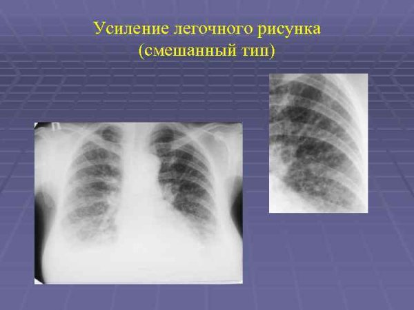 Патология легочного рисунка