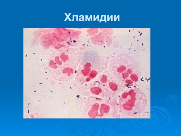 Хламидии Романовскому Гимзе