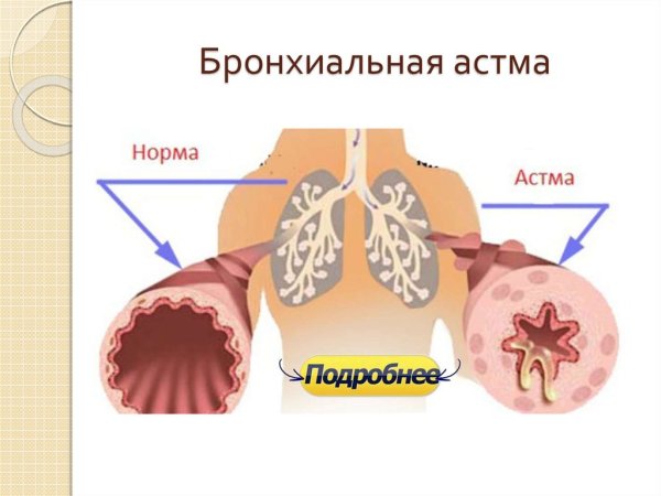 Афо бронхиальной астмы